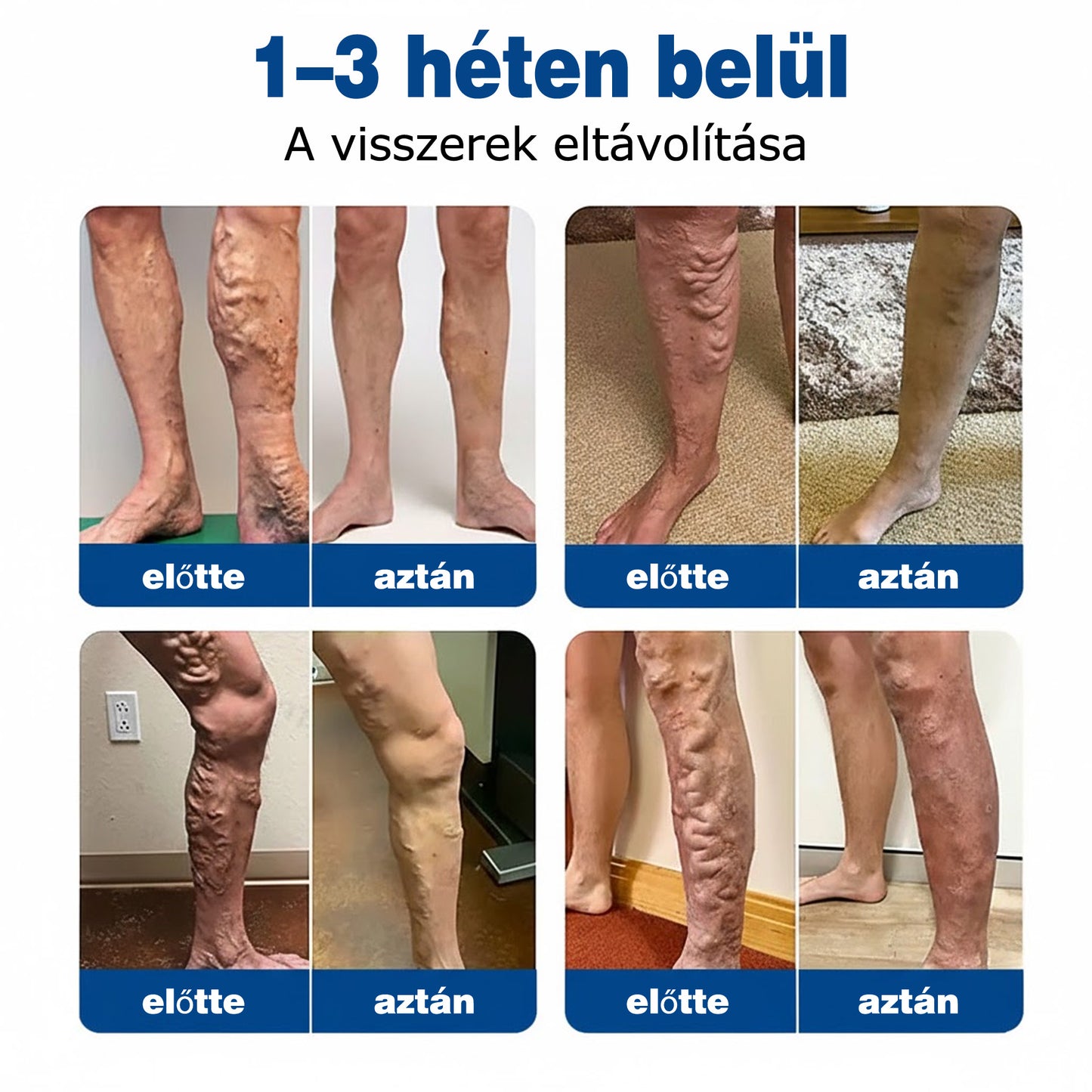 🇭🇺👨‍⚕️✅ GFOUK® VeinEase nano-mikrotűs tapasz a visszerek ápolására ⚡ Azonnali enyhülés, hosszú távú eredmények