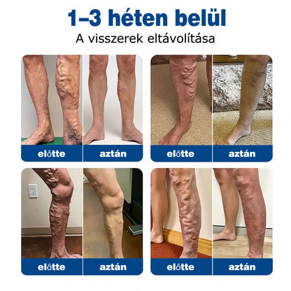 🇭🇺👨‍⚕️✅ GFOUK® VeinEase nano-mikrotűs tapasz a visszerek ápolására ⚡ Azonnali enyhülés, hosszú távú eredmények