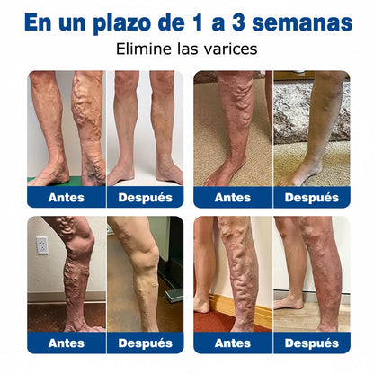 🇭🇺👨‍⚕️✅ GFOUK® VeinEase nano-mikrotűs tapasz a visszerek ápolására ⚡ Azonnali enyhülés, hosszú távú eredmények
